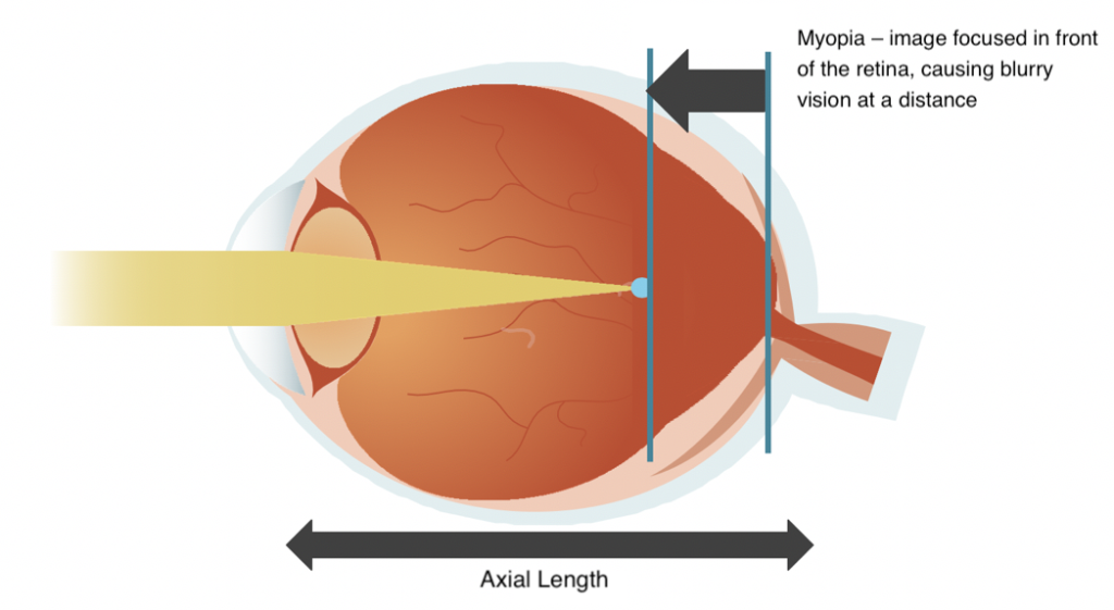 A diagram of an elongated eyeball, showing what happens when a child gets myopia