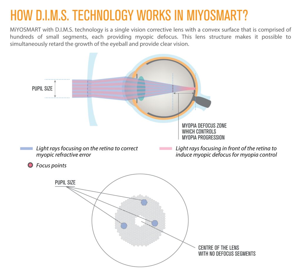 MiyoSmart Lens Diagram